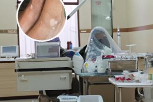 他克莫司治疗白斑怎样